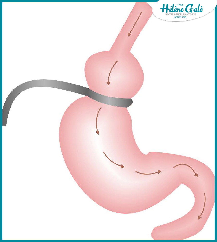 Le centre d’amincissement anti-âge Hélène Galé spécialisé dans la presso thérapie, drainage lymphatique et les jambes lourdes vous propose la cryolipolyse pour mincir et maigrir pas le froid pour les hommes comme pour les femmes à Tarbes 65000 et Pau.