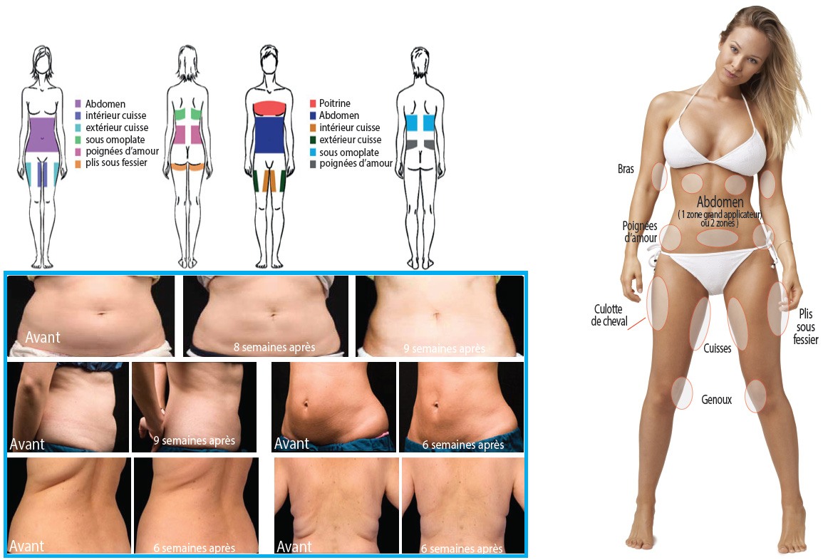 Le centre d’amincissement anti-âge Hélène Galé spécialisé dans la presso thérapie, drainage lymphatique et les jambes lourdes vous propose la cryolipolyse pour mincir et maigrir par le froid pour les hommes comme pour les femmes à Tarbes 65000 et Pau.